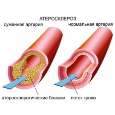 ХОЛЕСТЕРИН НЕБЕЗПЕЧНІШЕ ДЛЯ ЧОЛОВІКІВ.